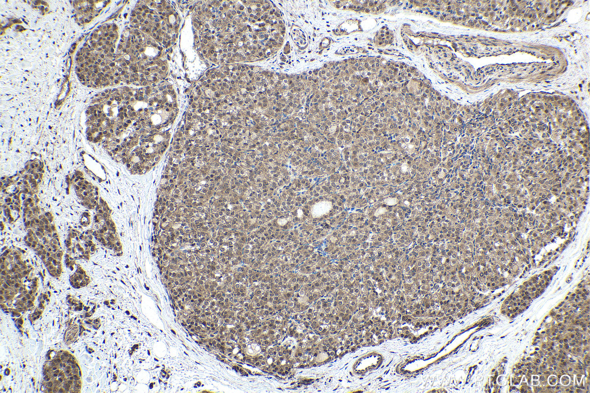 Immunohistochemical analysis of paraffin-embedded human thyroid cancer tissue slide using KHC1779 (CEP162 IHC Kit).