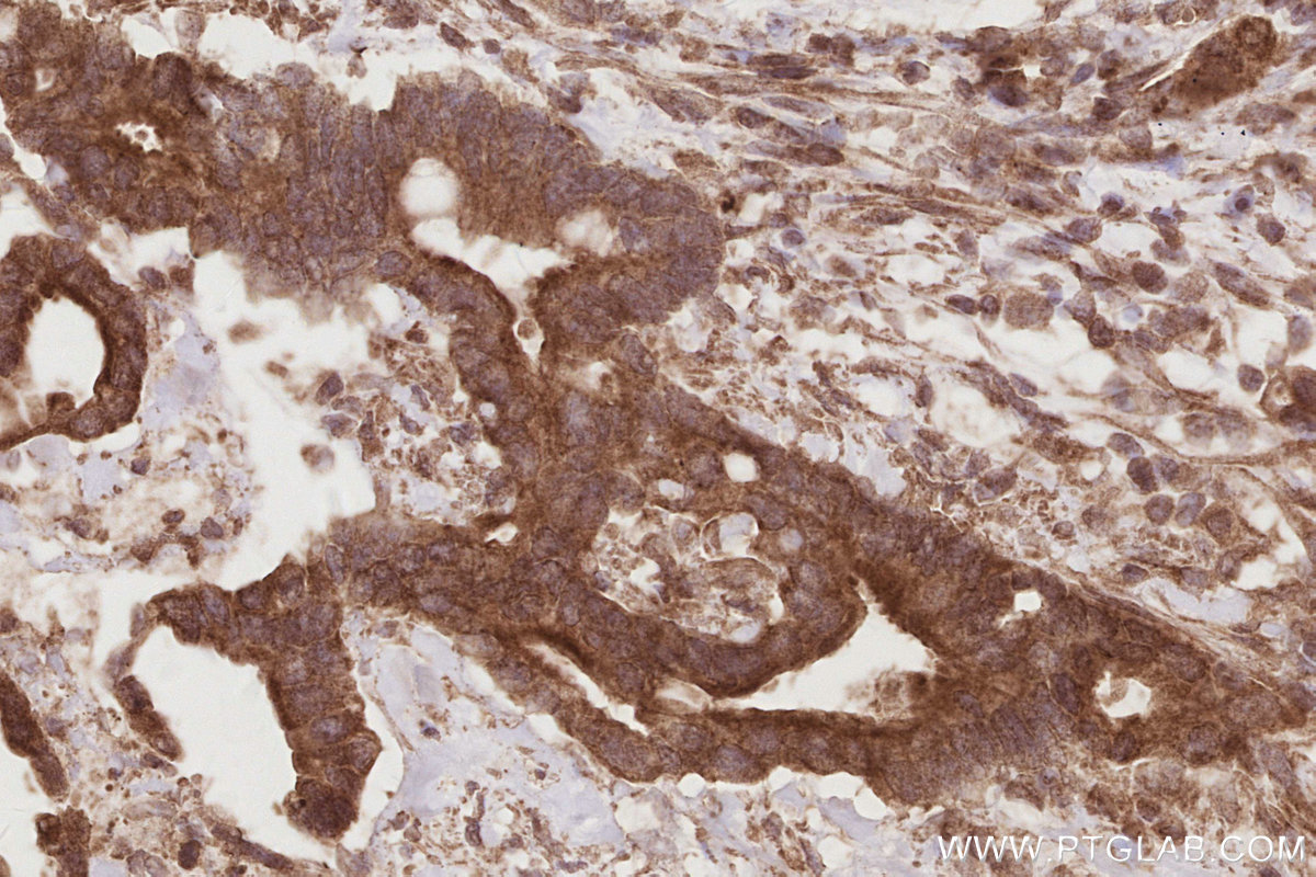 Immunohistochemical analysis of paraffin-embedded human rectal cancer tissue slide using KHC2872 (CEP250/CNAP1 IHC Kit).