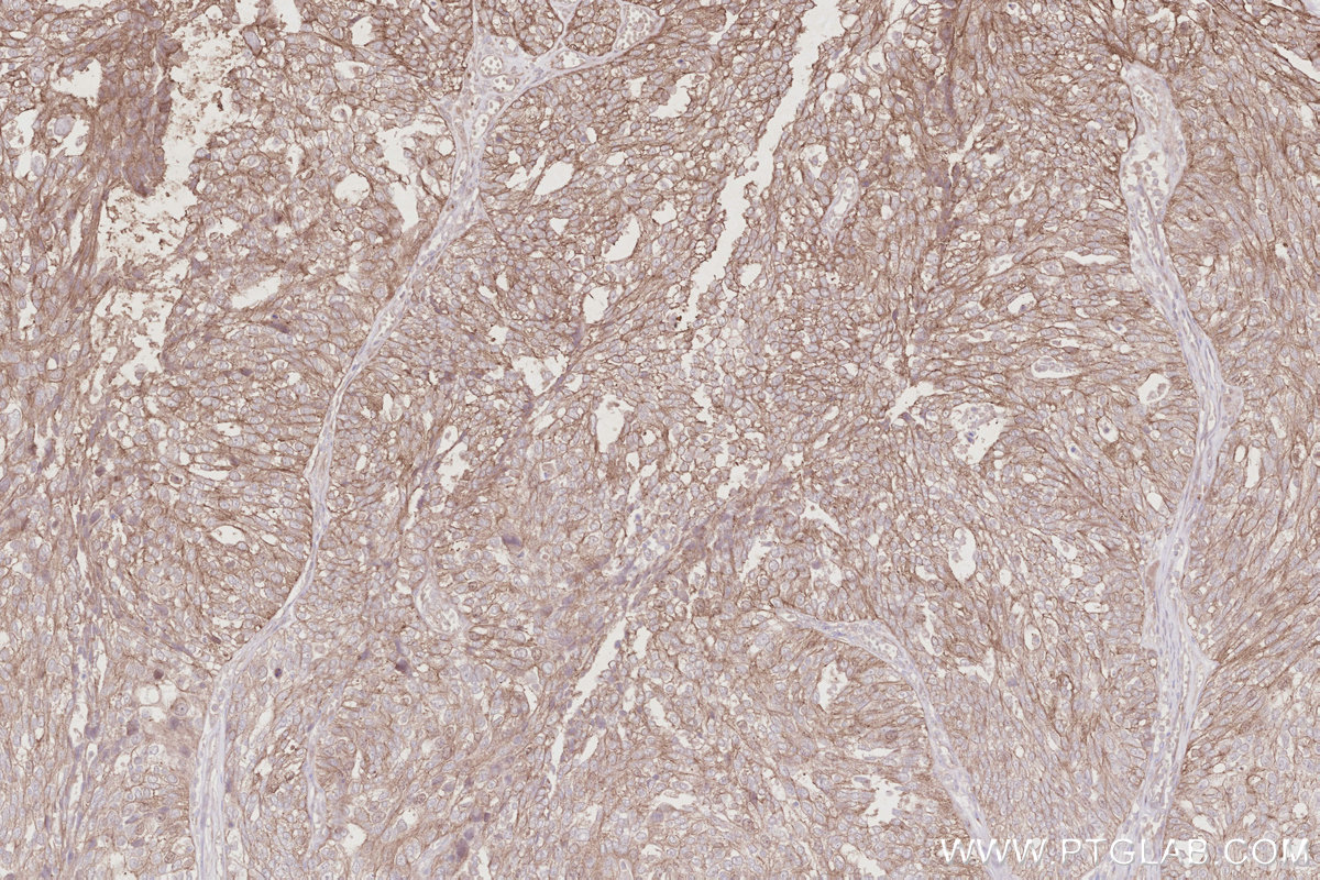 Immunohistochemical analysis of paraffin-embedded human ovary cancer tissue slide using KHC2892 (CEP295 IHC Kit). Immunohistochemical analysis of paraffin-embedded human ovary cancer tissue slide using KHC2892 (CEP295 IHC Kit).
