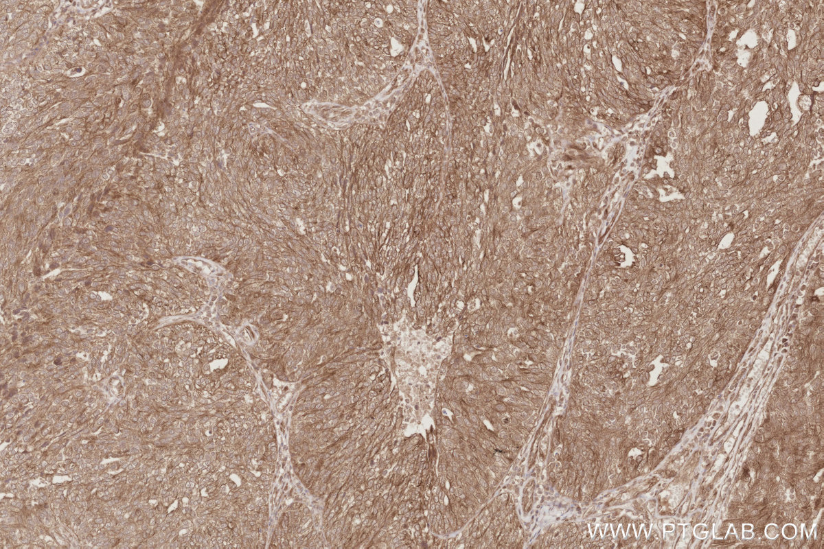Immunohistochemical analysis of paraffin-embedded human ovary cancer tissue slide using KHC2894 (CEP44 IHC Kit).