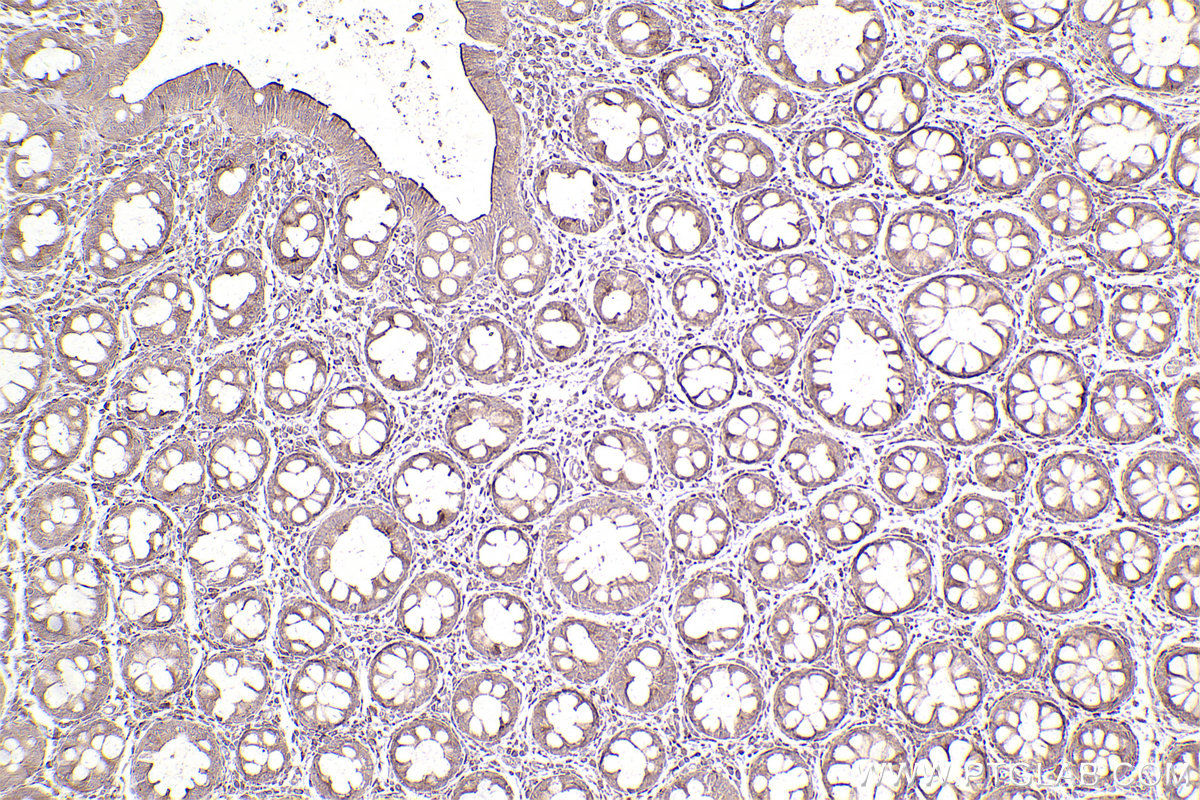 Immunohistochemical analysis of paraffin-embedded human rectal cancer tissue slide using KHC2533 (CEP55 IHC Kit).