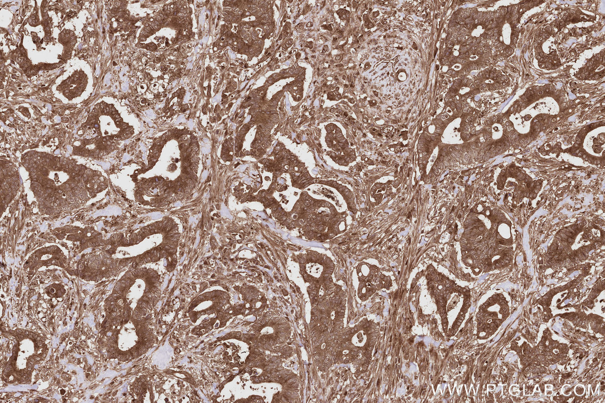 Immunohistochemical analysis of paraffin-embedded human rectal cancer tissue slide using KHC2807 (CEP63 IHC Kit).