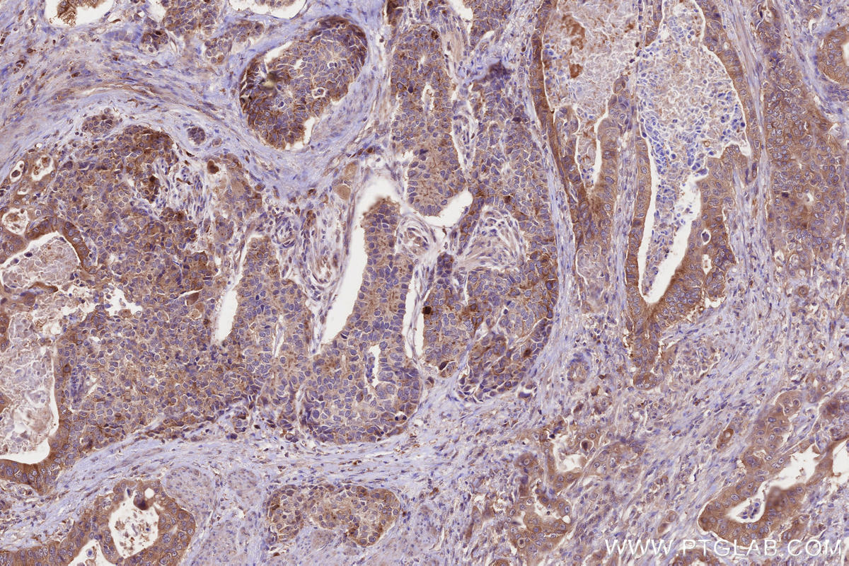 Immunohistochemical analysis of paraffin-embedded human stomach cancer tissue slide using KHC2649 (CEP97 IHC Kit).
