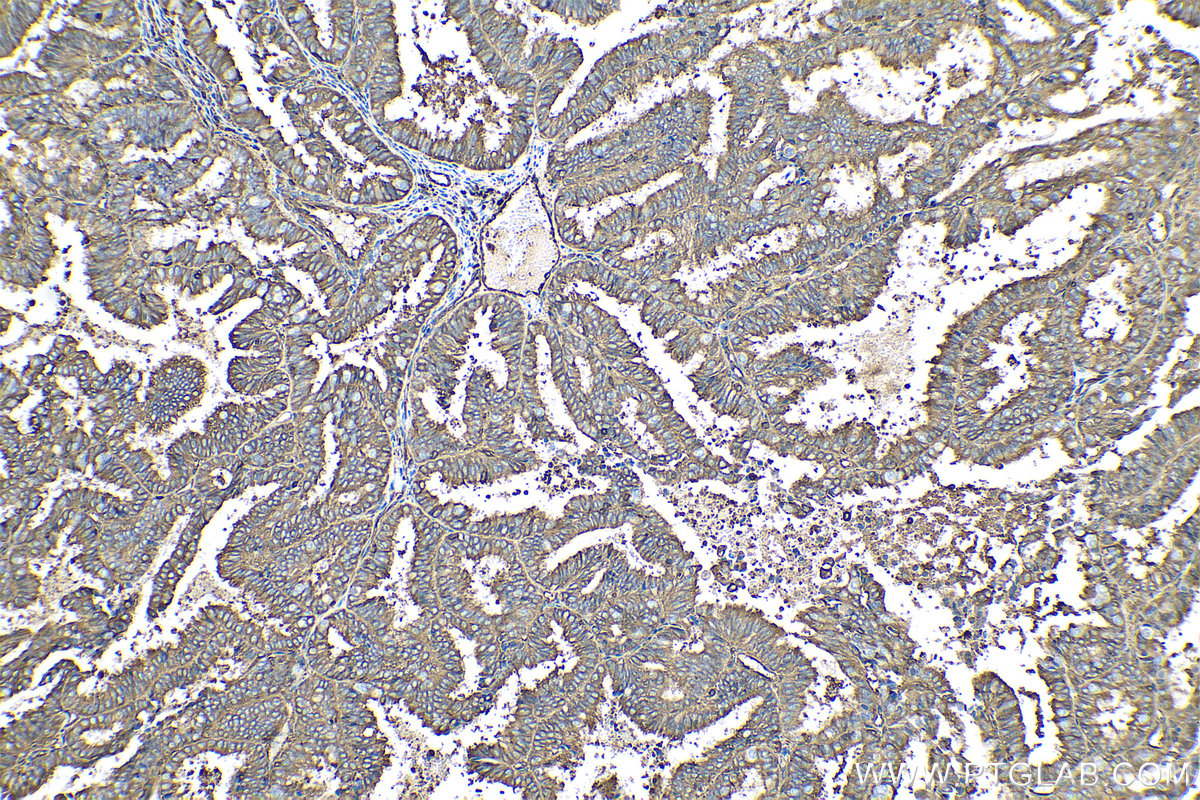 Immunohistochemical analysis of paraffin-embedded human ovary tumor tissue slide using KHC0534 (CFL1 IHC Kit).