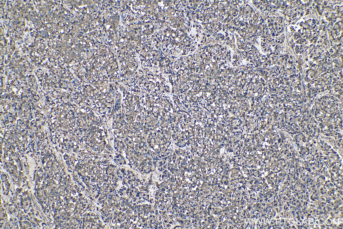 Immunohistochemical analysis of paraffin-embedded human colon cancer tissue slide using KHC0534 (CFL1 IHC Kit).