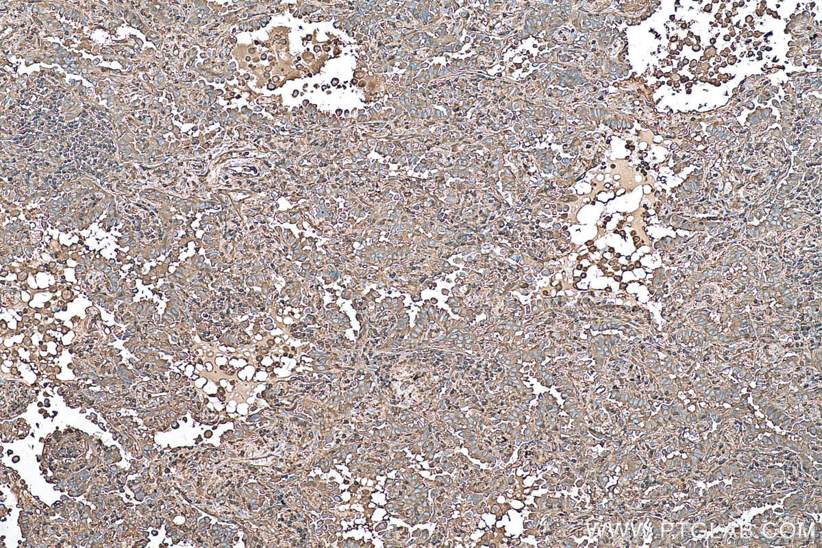 Immunohistochemical analysis of paraffin-embedded human lung cancer tissue slide using KHC0534 (CFL1 IHC Kit).