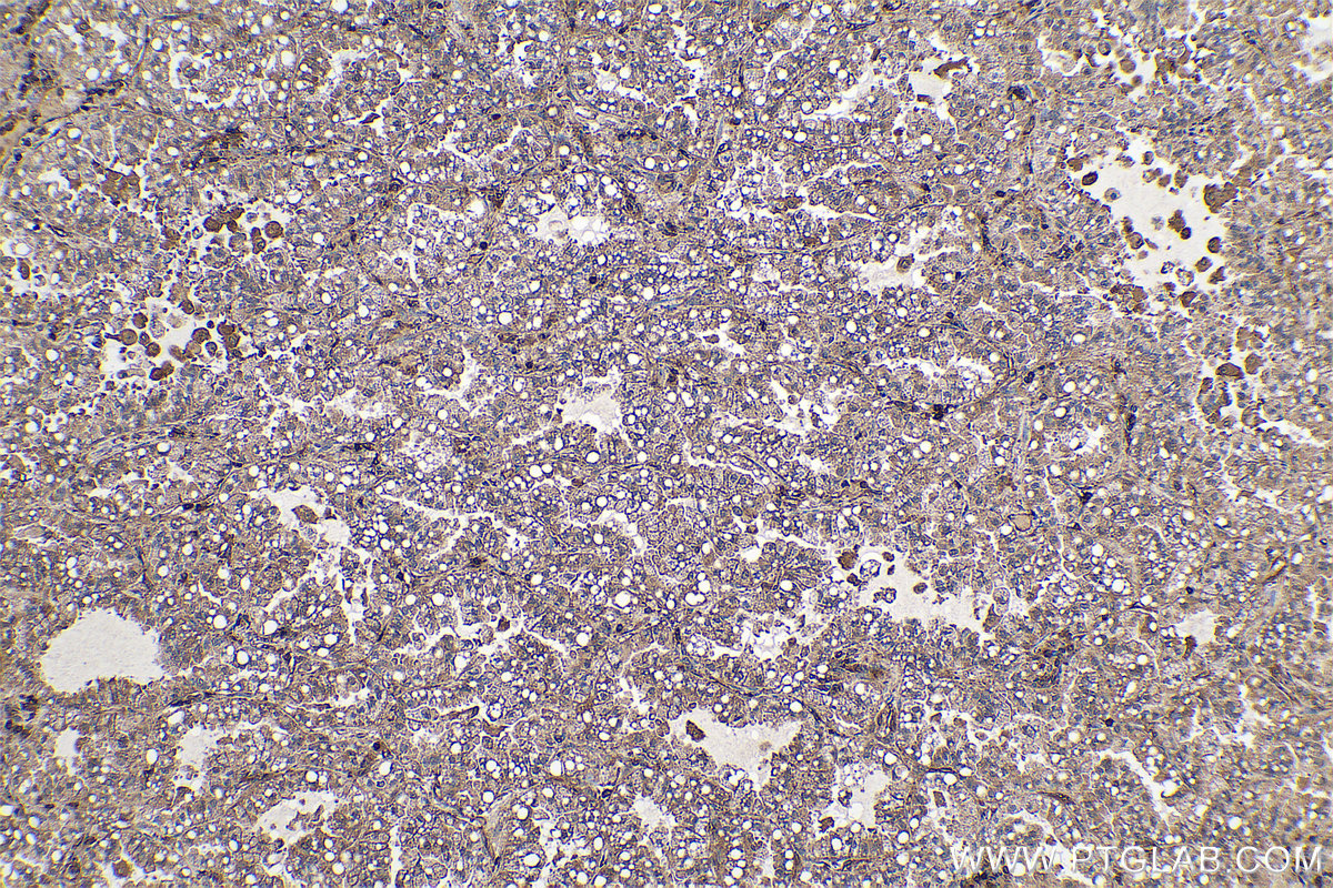 Immunohistochemical analysis of paraffin-embedded human lung cancer tissue slide using KHC0732 (CFL2 IHC Kit).