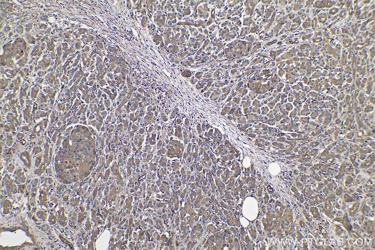 Immunohistochemical analysis of paraffin-embedded human pancreas cancer tissue slide using KHC0732 (CFL2 IHC Kit).