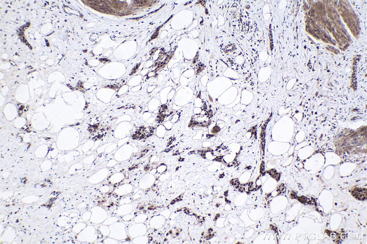 Immunohistochemical analysis of paraffin-embedded human urothelial carcinoma tissue slide using KHC1700 (CHAF1B IHC Kit).