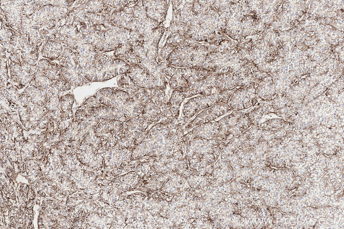 Immunohistochemical analysis of paraffin-embedded human renal cell carcinoma tissue slide using KHC3297 (CHST13 IHC Kit).