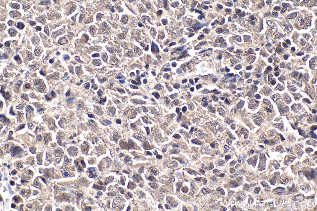 Immunohistochemical analysis of paraffin-embedded human malignant melanoma tissue slide using KHC1867 (CIDEC IHC Kit).