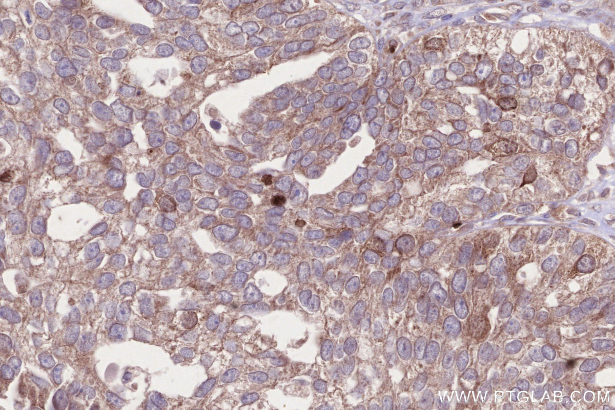 Immunohistochemical analysis of paraffin-embedded human ovary cancer tissue slide using KHC2658 (CKAP2L IHC Kit).