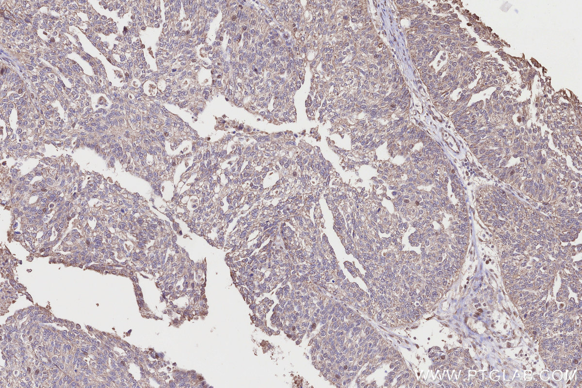 Immunohistochemical analysis of paraffin-embedded human ovary cancer tissue slide using KHC3223 (CLCN3 IHC Kit). Immunohistochemical analysis of paraffin-embedded human ovary cancer tissue slide using KHC3223 (CLCN3 IHC Kit).