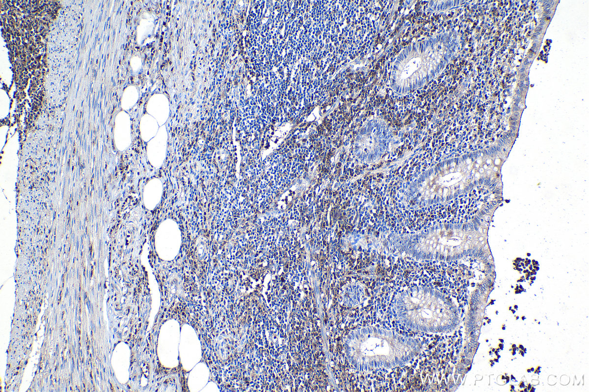 Immunohistochemical analysis of paraffin-embedded human appendicitis tissue slide using KHC1123 (CLEC12A IHC Kit).