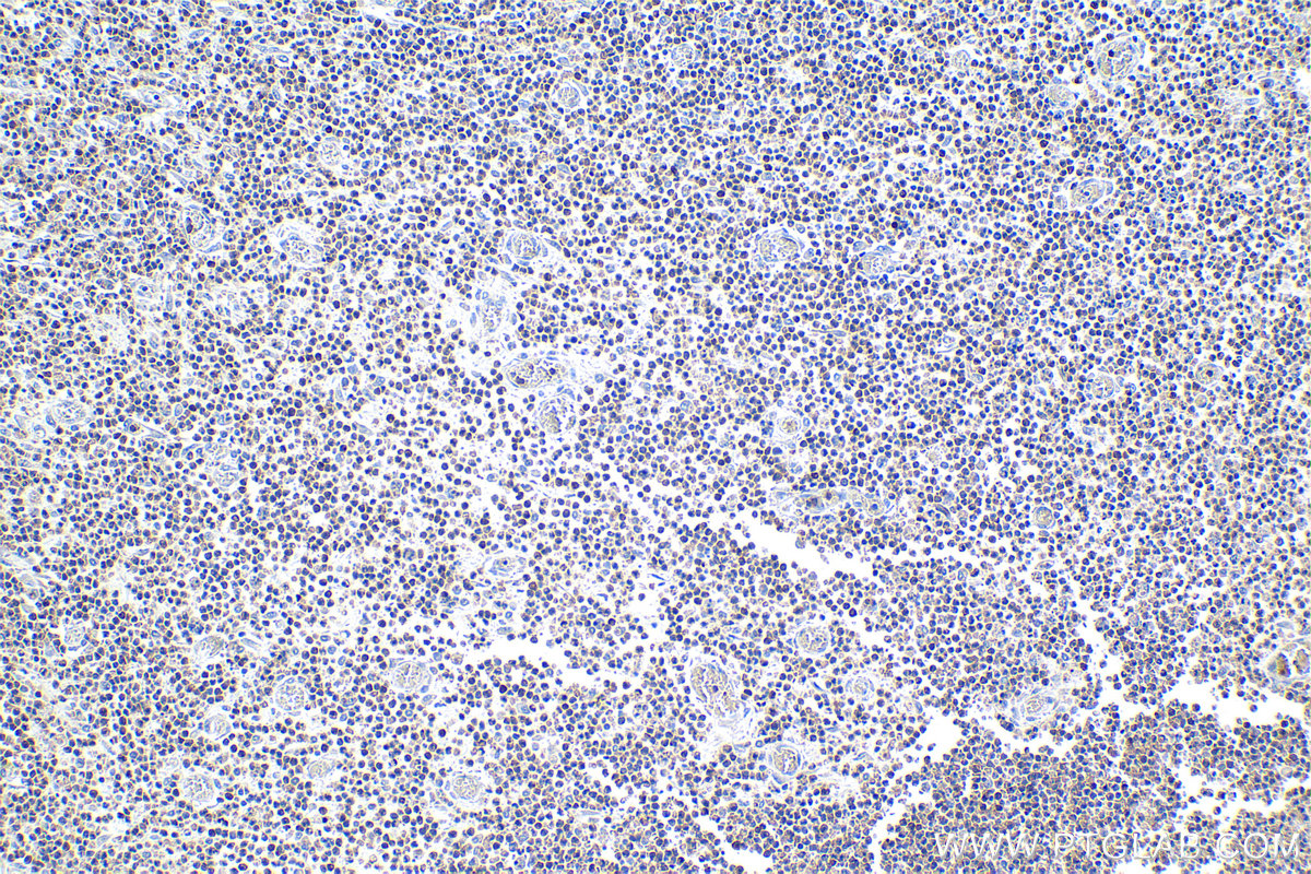 Immunohistochemical analysis of paraffin-embedded human colon cancer tissue slide using KHC1123 (CLEC12A IHC Kit).