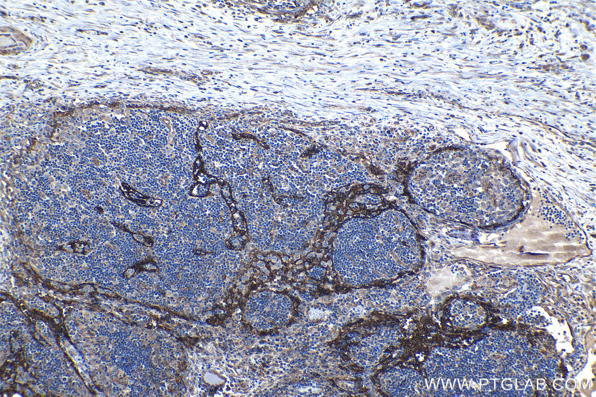 Immunohistochemical analysis of paraffin-embedded human lymphoma tissue slide using KHC1127 (CLEC4M IHC Kit).