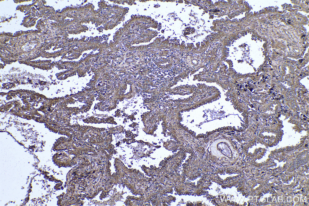 Immunohistochemical analysis of paraffin-embedded human lung cancer tissue slide using KHC0593 (CLTB IHC Kit).