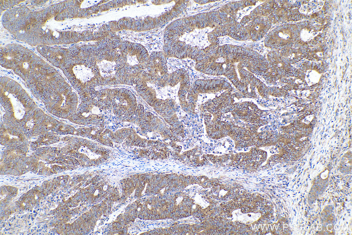 Immunohistochemical analysis of paraffin-embedded human colon cancer tissue slide using KHC0687 (CLTC IHC Kit).