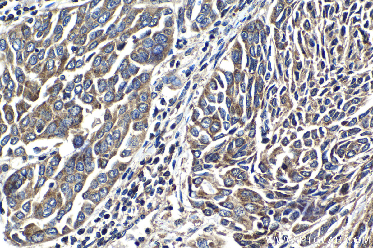 Immunohistochemical analysis of paraffin-embedded human oesophagus cancer tissue slide using KHC1392 (CLYBL IHC Kit).