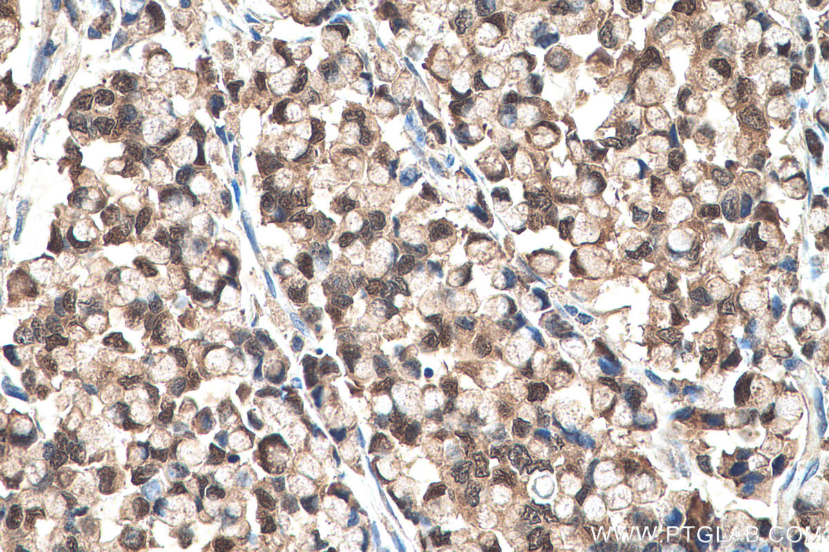 Immunohistochemical analysis of paraffin-embedded human colon cancer tissue slide using KHC0727 (CMPK1 IHC Kit).