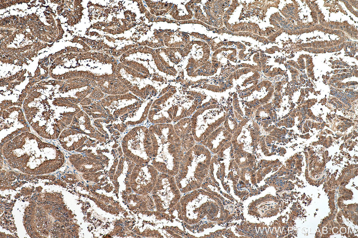 Immunohistochemical analysis of paraffin-embedded human ovary tumor tissue slide using KHC0727 (CMPK1 IHC Kit).