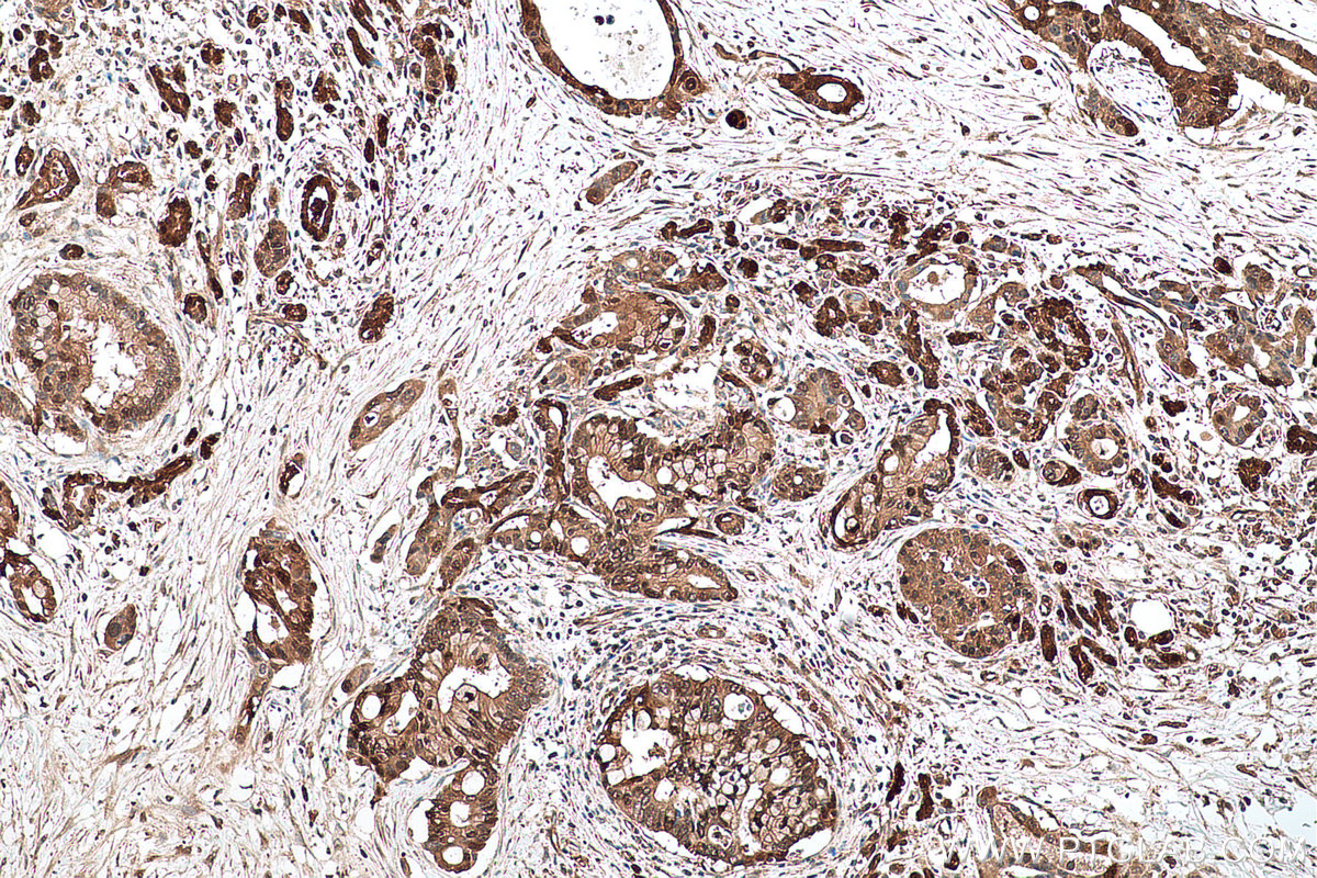 Immunohistochemical analysis of paraffin-embedded human pancreas cancer tissue slide using KHC0727 (CMPK1 IHC Kit).