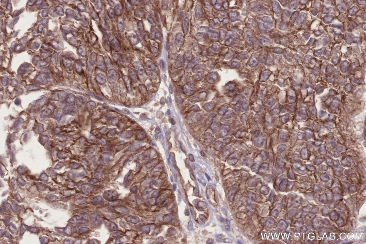 Immunohistochemical analysis of paraffin-embedded human ovary cancer tissue slide using KHC2690 (CNNM3 IHC Kit).