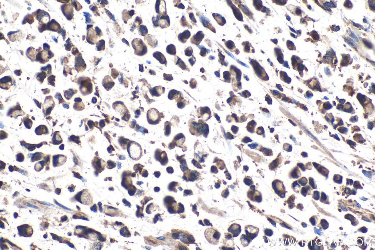 Immunohistochemical analysis of paraffin-embedded human stomach cancer tissue slide using KHC1415 (CNOT1 IHC Kit).