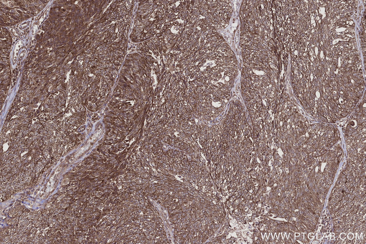 Immunohistochemical analysis of paraffin-embedded human ovary cancer tissue slide using KHC2925 (CNOT10 IHC Kit).