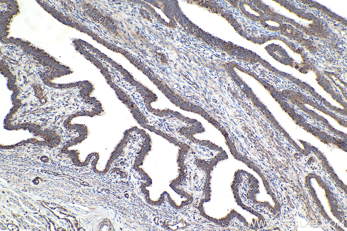 Immunohistochemical analysis of paraffin-embedded human ovary tumor tissue slide using KHC1973 (CNOT2 IHC Kit).
