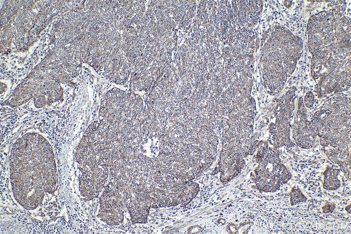 Immunohistochemical analysis of paraffin-embedded human cervical cancer tissue slide using KHC1973 (CNOT2 IHC Kit).