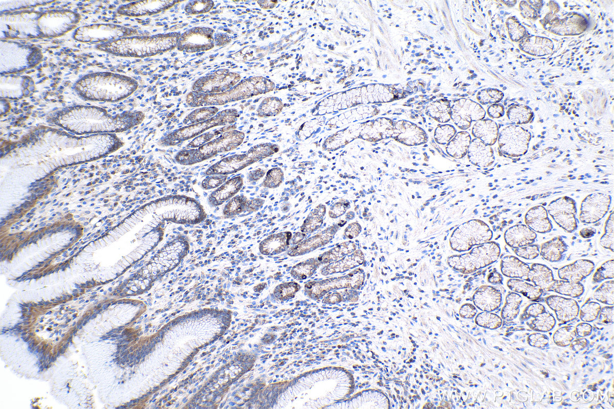 Immunohistochemical analysis of paraffin-embedded human stomach cancer tissue slide using KHC0999 (CNOT9 IHC Kit).