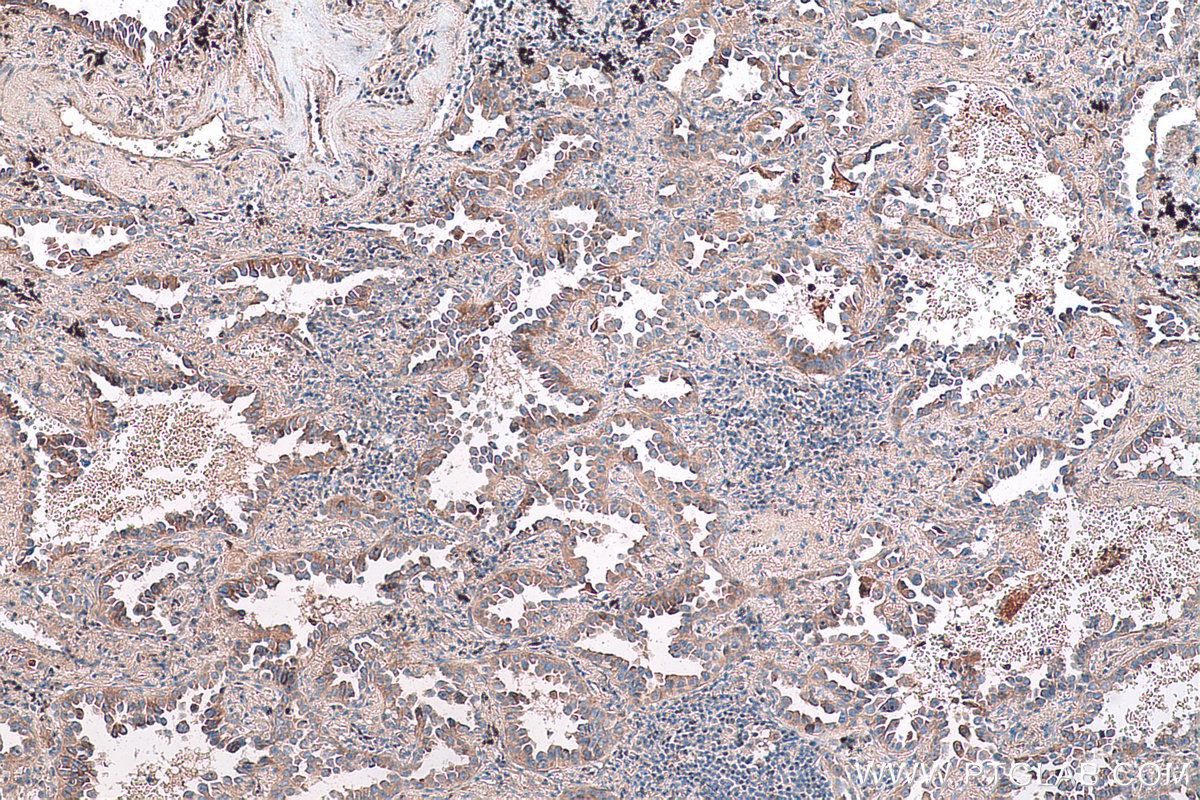 Immunohistochemical analysis of paraffin-embedded human lung cancer tissue slide using KHC0744 (COL11A1 IHC Kit).