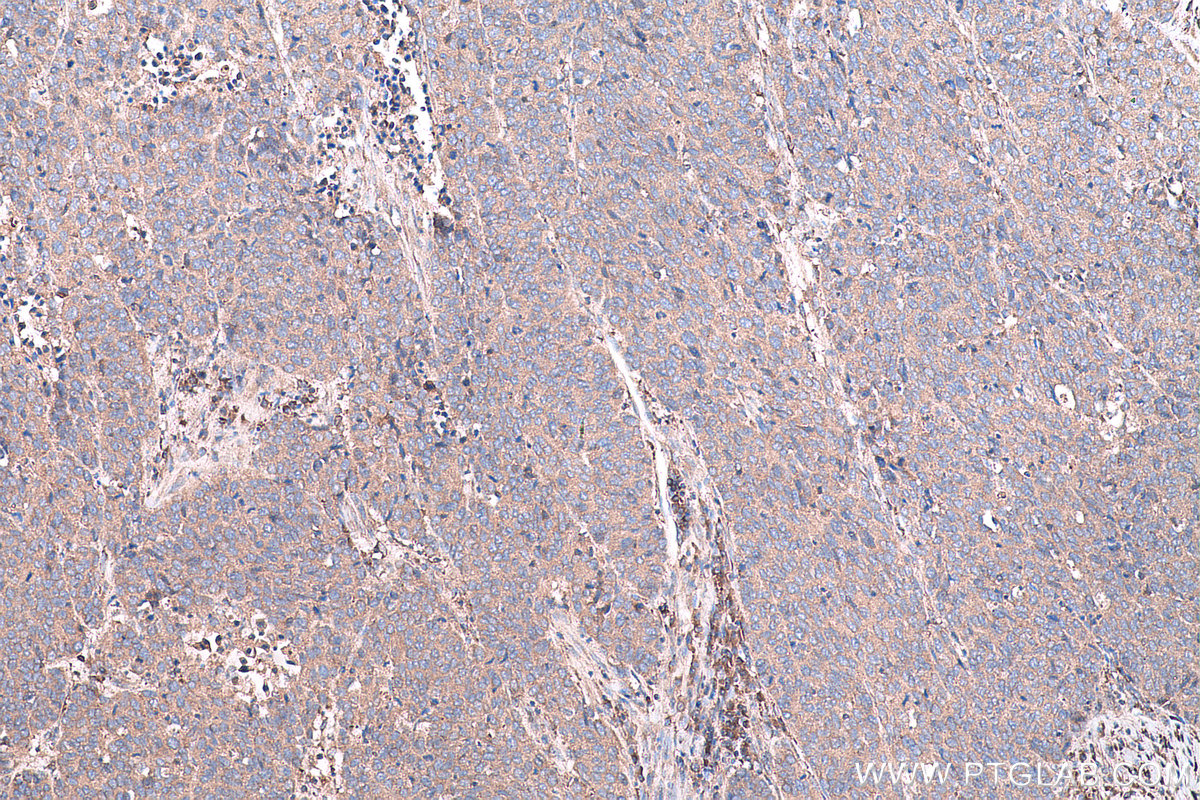 Immunohistochemical analysis of paraffin-embedded human stomach cancer tissue slide using KHC0744 (COL11A1 IHC Kit).