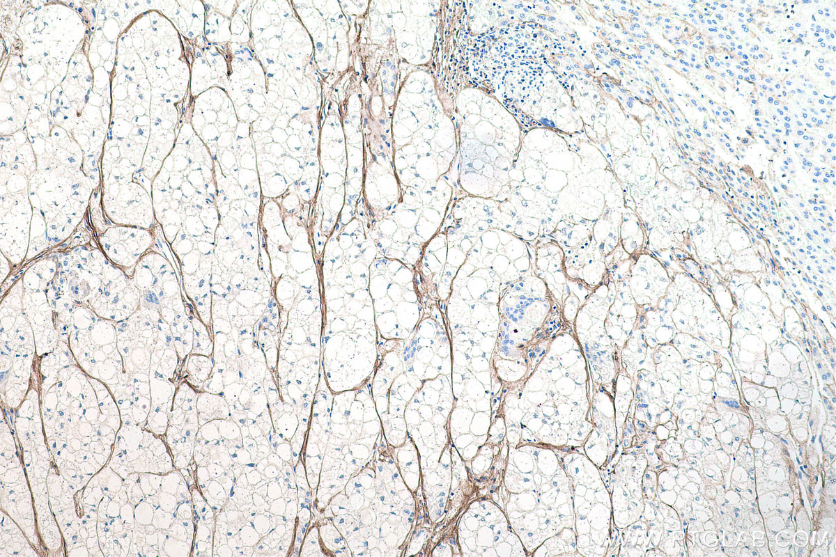 Immunohistochemical analysis of paraffin-embedded human liver cancer tissue slide using KHC0205 (COL1A1 IHC Kit).