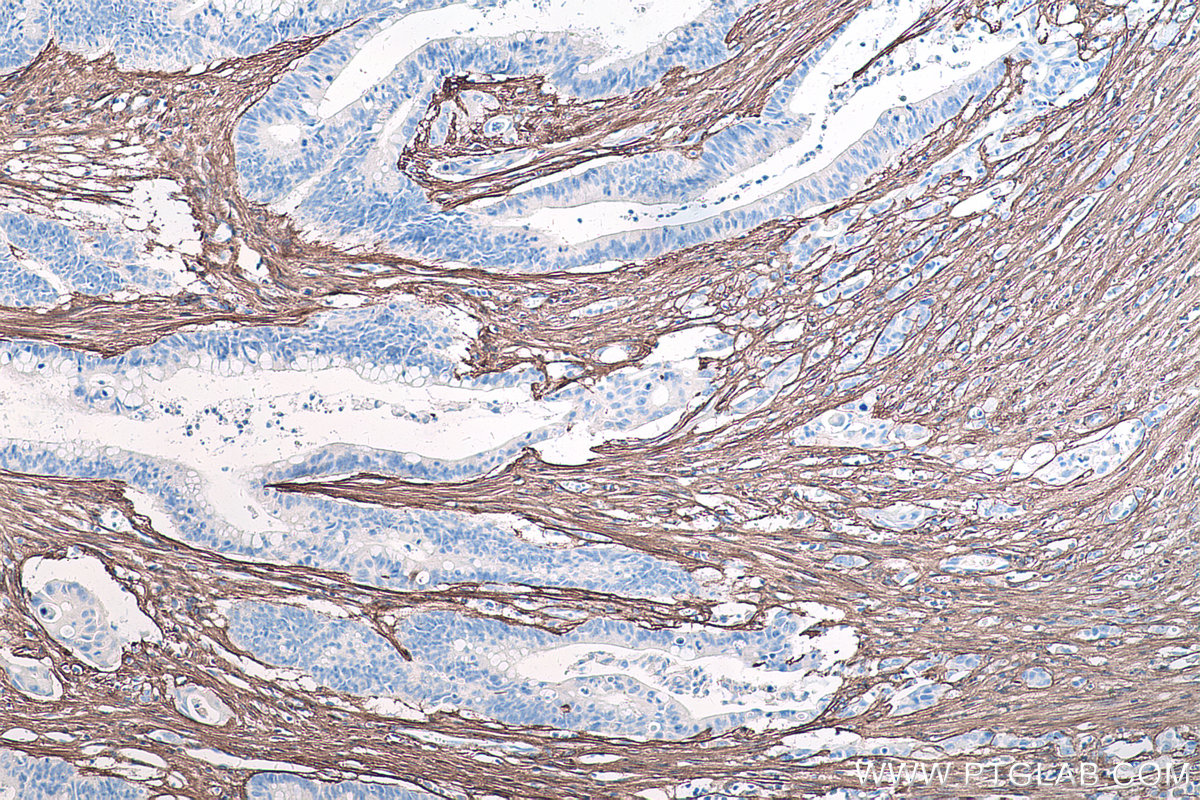 Immunohistochemical analysis of paraffin-embedded human colon cancer tissue slide using KHC0264 (COL3A1 IHC Kit).