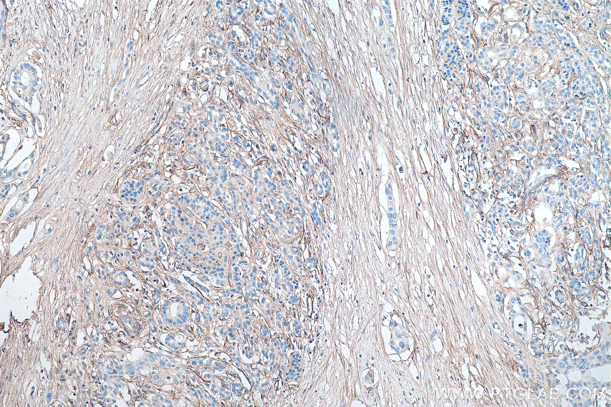 Immunohistochemical analysis of paraffin-embedded human pancreas cancer tissue slide using KHC0314 (COL6A1 IHC Kit).