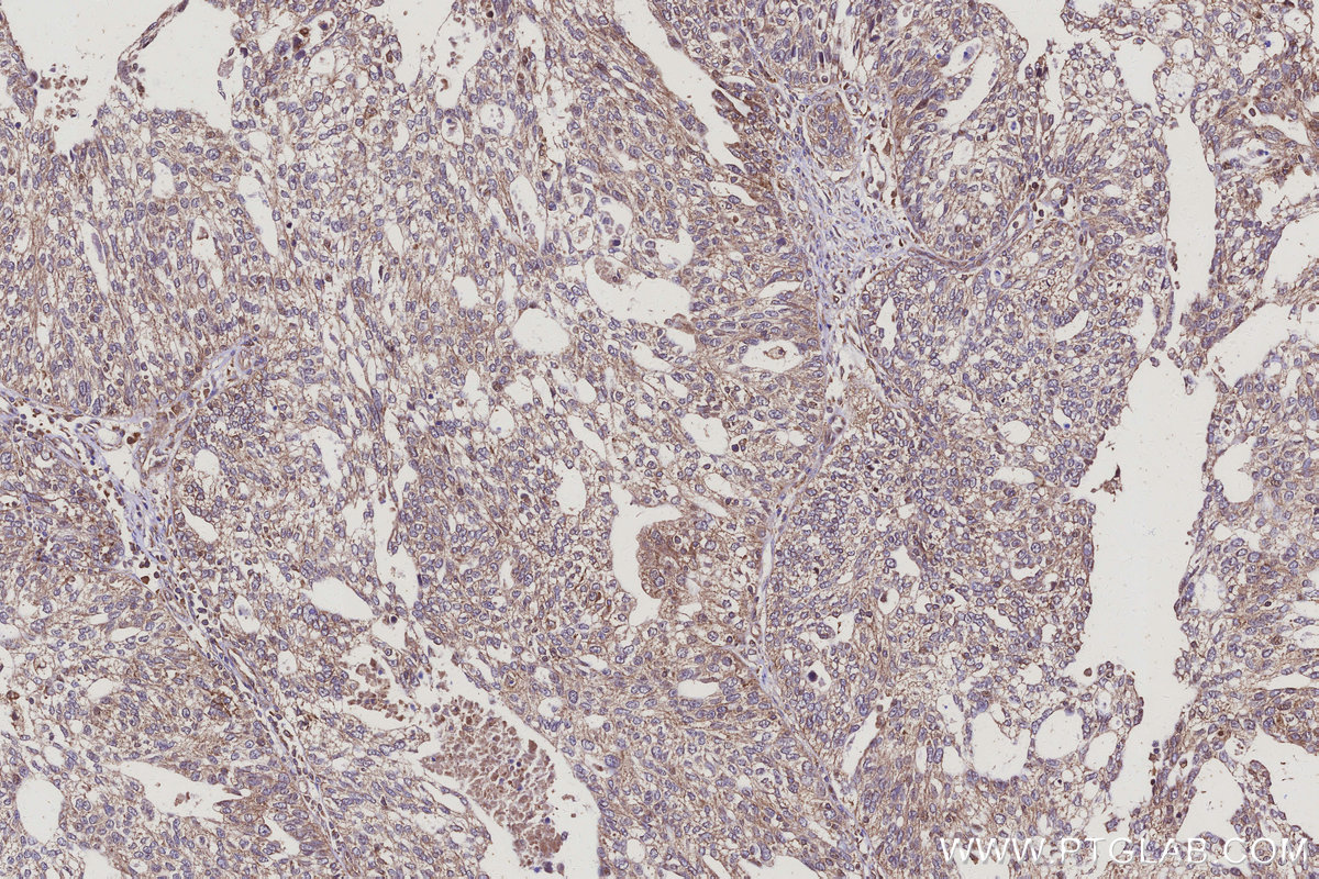 Immunohistochemical analysis of paraffin-embedded human ovary cancer tissue slide using KHC3117 (COMMD5 IHC Kit). Immunohistochemical analysis of paraffin-embedded human ovary cancer tissue slide using KHC3117 (COMMD5 IHC Kit).