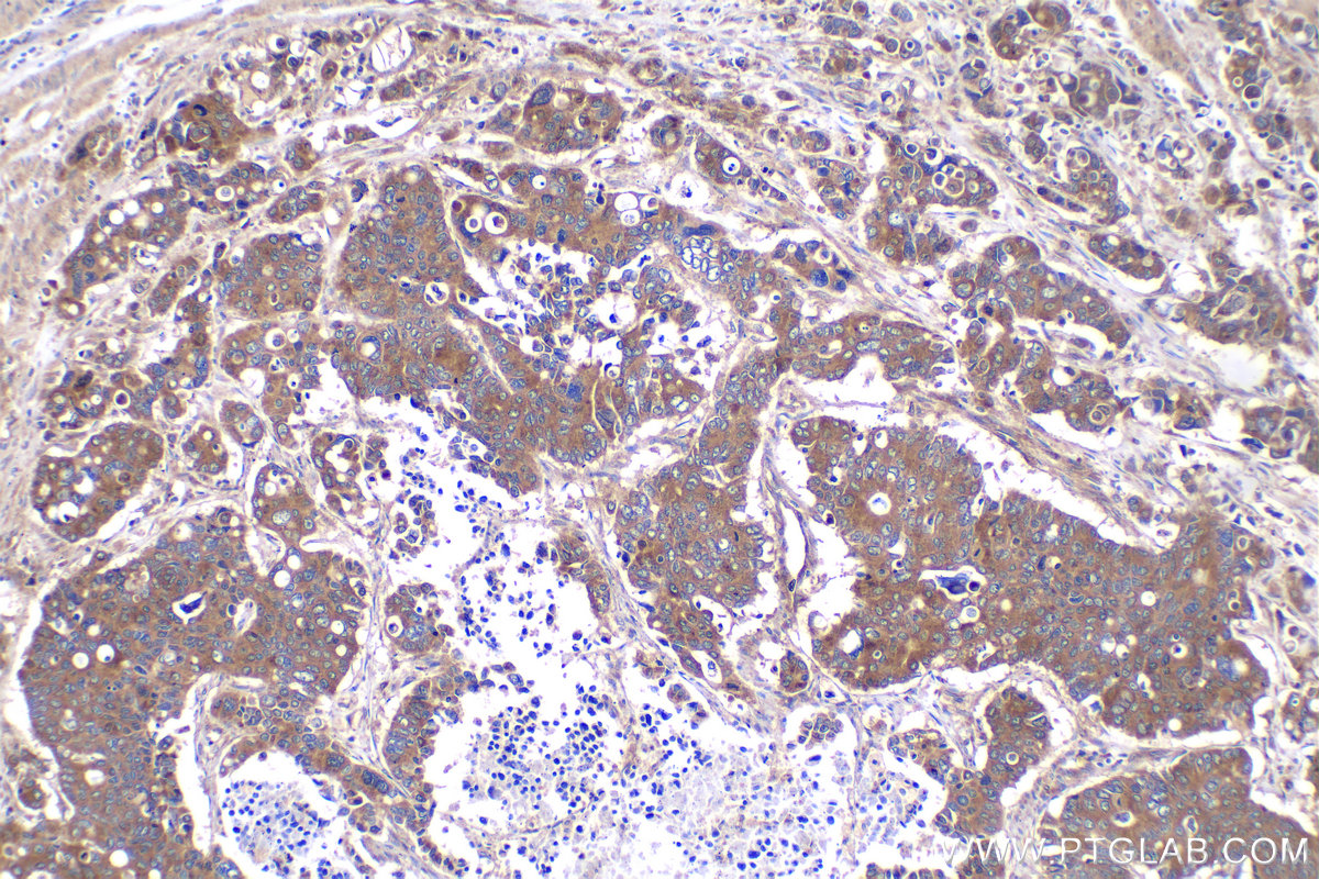 Immunohistochemical analysis of paraffin-embedded human stomach cancer tissue slide using KHC2056 (COPE IHC Kit).