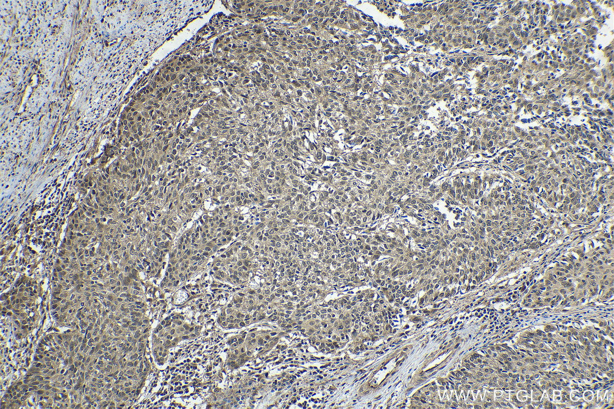 Immunohistochemical analysis of paraffin-embedded human cervical cancer tissue slide using KHC1639 (COPS2 IHC Kit).