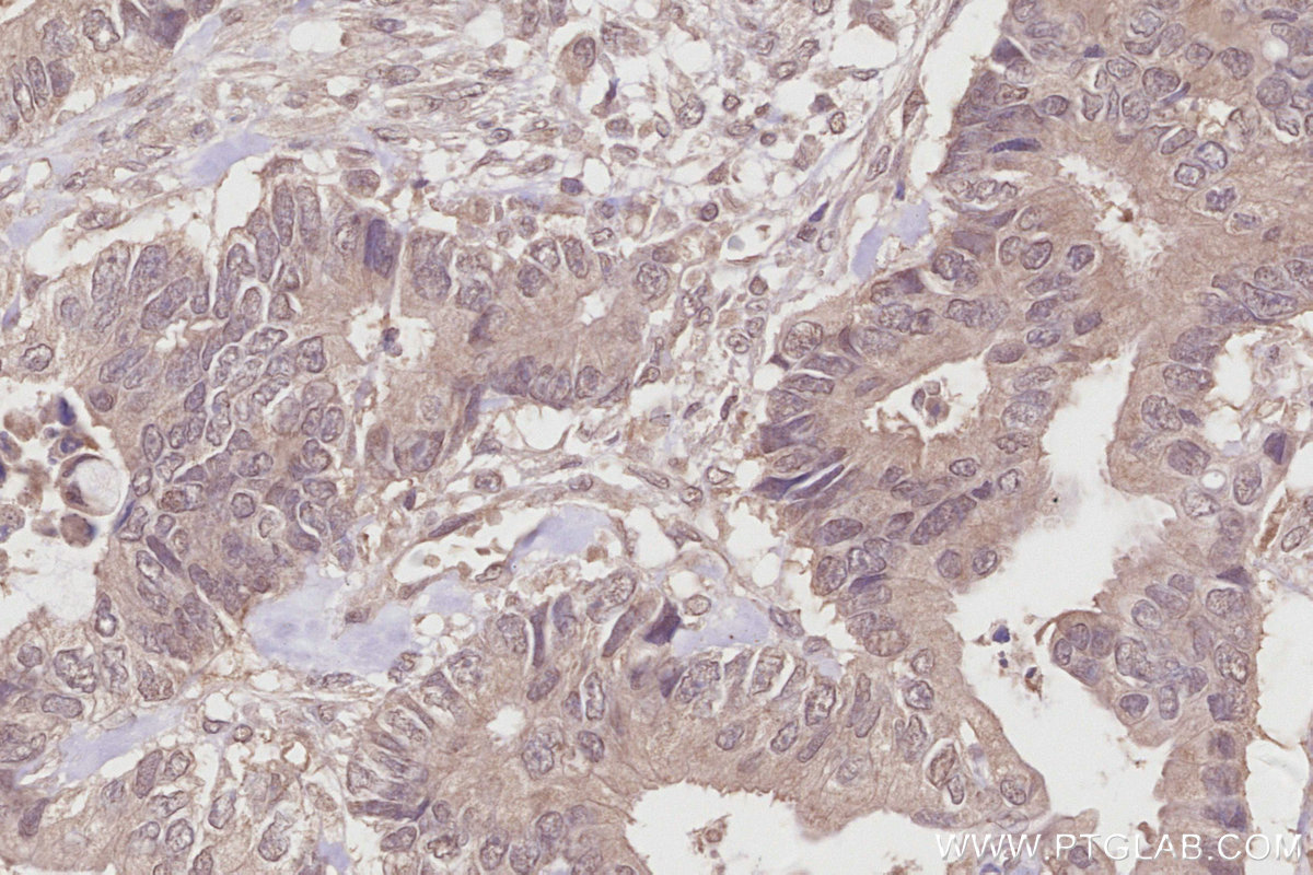 Immunohistochemical analysis of paraffin-embedded human rectal cancer tissue slide using KHC2864 (COPS4 IHC Kit).