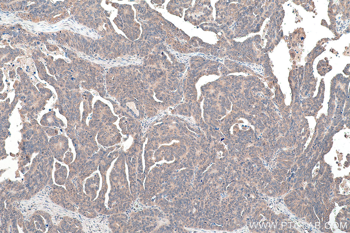 Immunohistochemical analysis of paraffin-embedded human ovary tumor tissue slide using KHC0921 (COPS5/JAB1 IHC Kit).