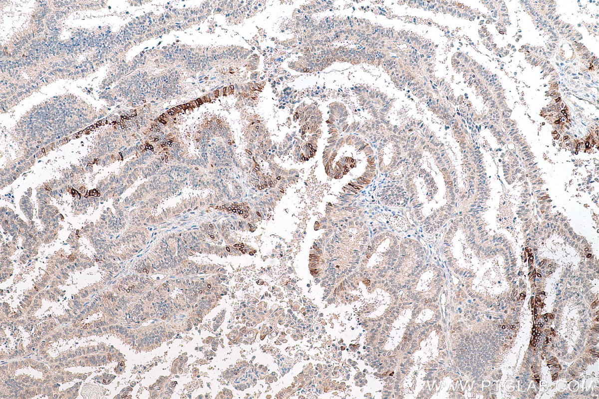 Immunohistochemical analysis of paraffin-embedded human ovary tumor tissue slide using KHC0770 (COX2 IHC Kit).