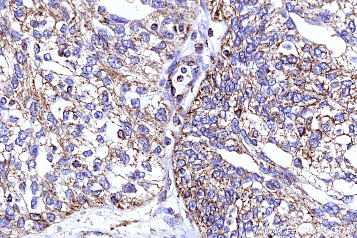 Immunohistochemical analysis of paraffin-embedded human ovary cancer tissue slide using KHC3176 (COX5B IHC Kit).