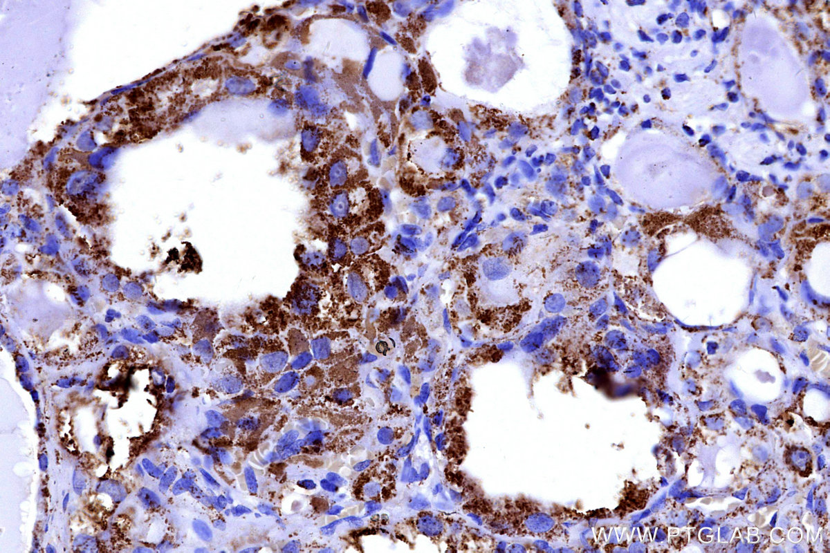 Immunohistochemical analysis of paraffin-embedded human thyroid cancer tissue slide using KHC3176 (COX5B IHC Kit).