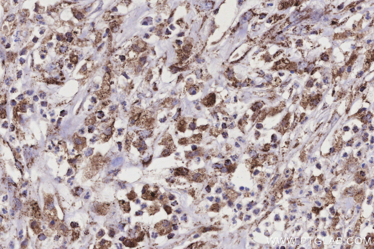 Immunohistochemical analysis of paraffin-embedded human colon cancer tissue slide using KHC3179 (COX6A1 IHC Kit).