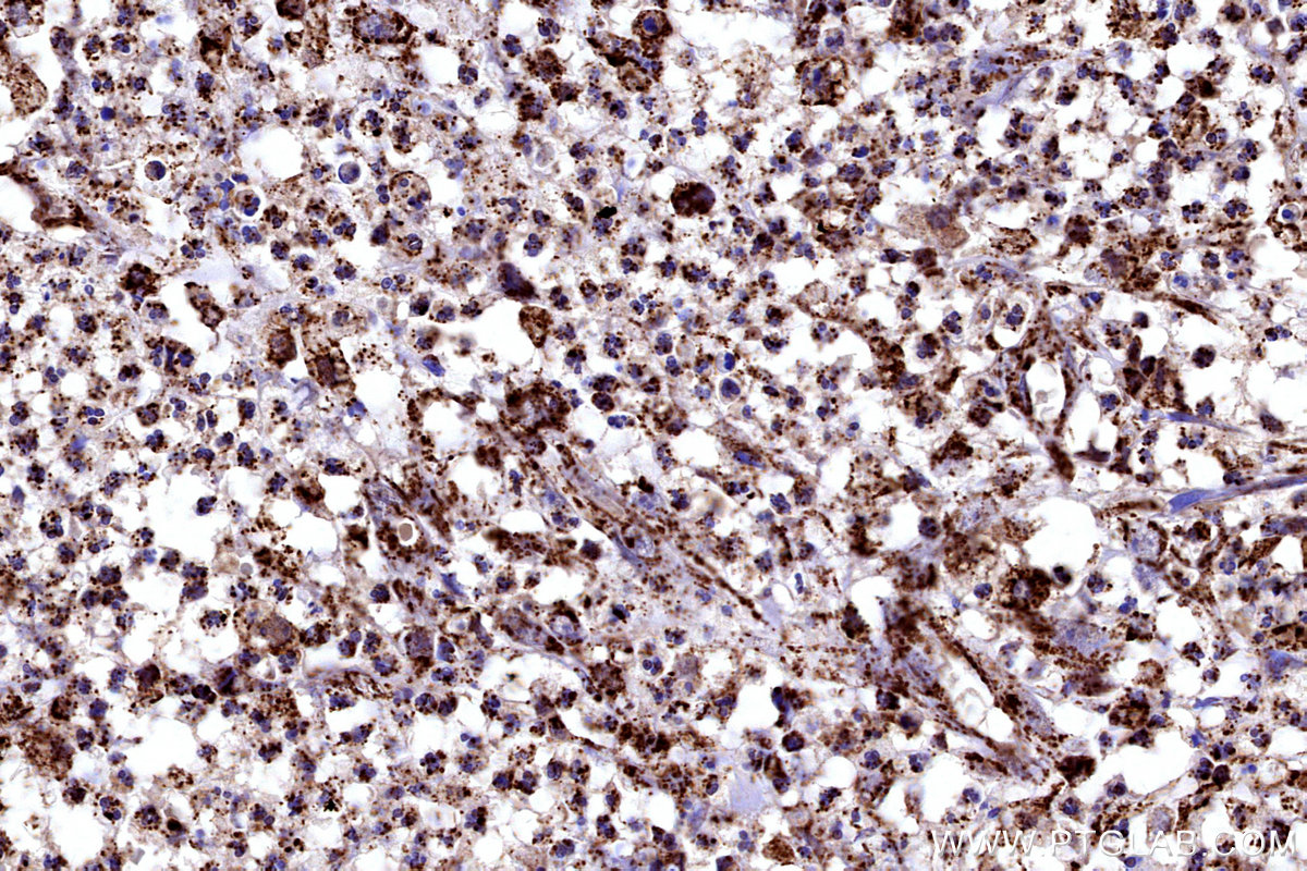 Immunohistochemical analysis of paraffin-embedded human colon cancer tissue slide using KHC3183 (COX6B1 IHC Kit).