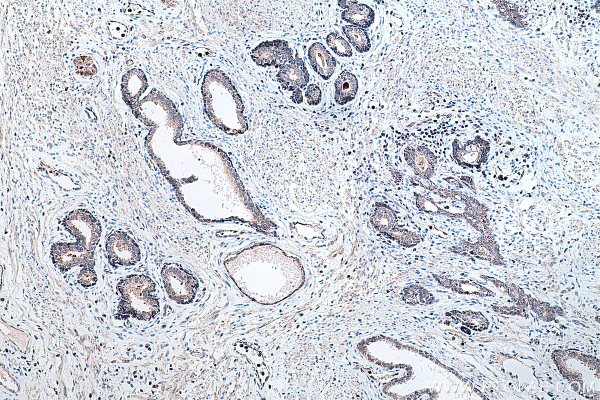 Immunohistochemical analysis of paraffin-embedded human prostate cancer tissue slide using KHC0305 (COX8A IHC Kit).