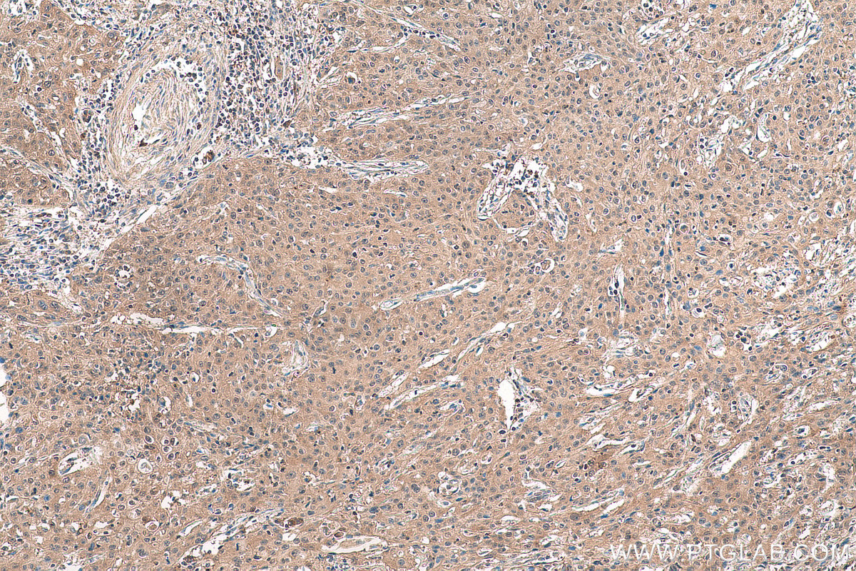 Immunohistochemical analysis of paraffin-embedded human cervical cancer tissue slide using KHC0962 (CPNE1 IHC Kit).