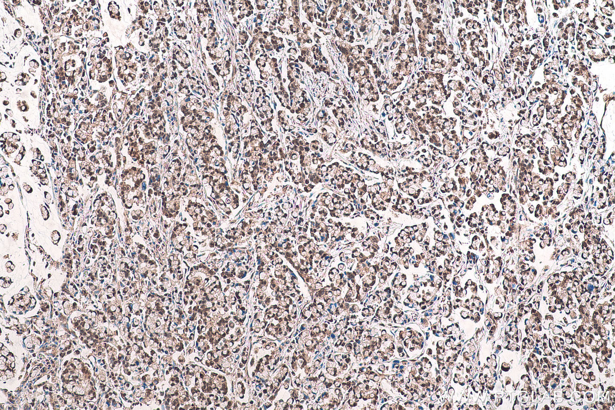 Immunohistochemical analysis of paraffin-embedded human colon cancer tissue slide using KHC0962 (CPNE1 IHC Kit).